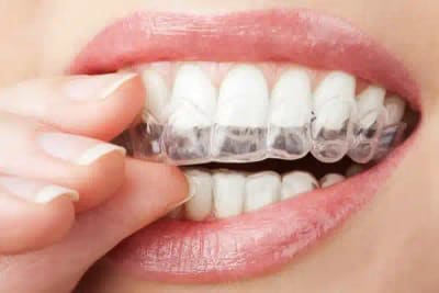 Invisalign & Orthodontics at Honest Teeth Dentistry in Elm Grove